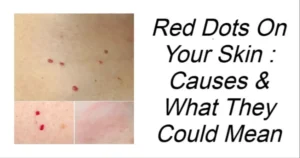 Read more about the article Red Dots On Your Skin : Causes & What They Could Mean