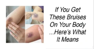 Read more about the article What Bruises On Your Body Could Be Telling You