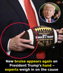 Read more about the article Trump’s Recurring Bruise Sparks Concern: What It Could Mean for His Health