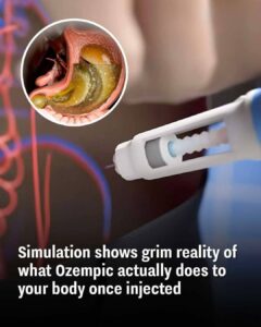Read more about the article The Hidden Dangers of Ozempic: What You Need to Know Before Using It for Weight Loss