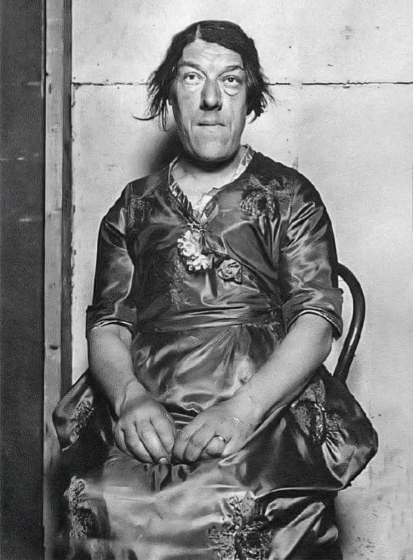 You are currently viewing Mary Ann Bevan: The Tragic Life of “The Ugliest Woman in the World” and Her Struggle for Survival