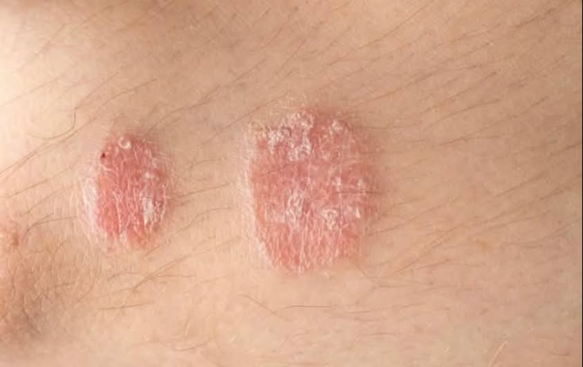 Read more about the article Warning Signs of Psoriasis: Don’t Ignore These Skin Symptoms