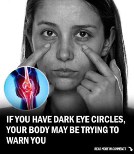 Read more about the article Dark Circles Under Eyes: A Warning Sign of Potential Health Issues