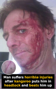 Read more about the article Man Suffers Serious Injury After Kangaroo Attack: A Painful Lesson in Wildlife Encounters