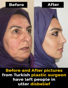 Read more about the article Plastic Surgery in Turkey: A Game-Changer for Cosmetic Treatments