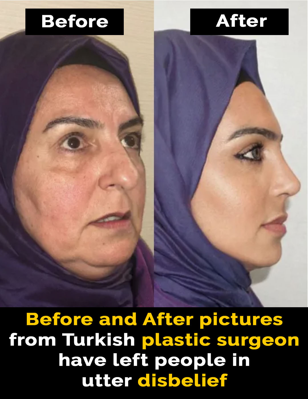 Read more about the article Plastic Surgery in Turkey: A Game-Changer for Cosmetic Treatments