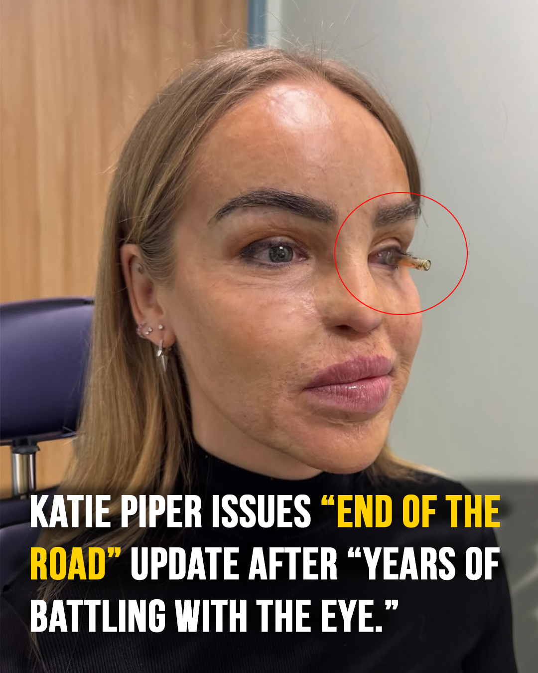 Read more about the article Katie Piper’s Courageous Decision to Try a Prosthetic Eye After Years of Health Struggles