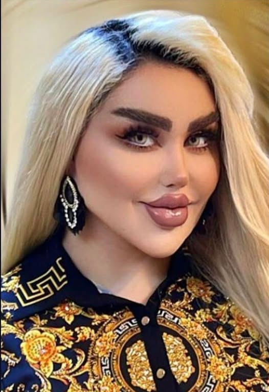 You are currently viewing Woman’s 43 Operations to Look Like Barbie: A Cautionary Tale of Beauty and Self-Transformation