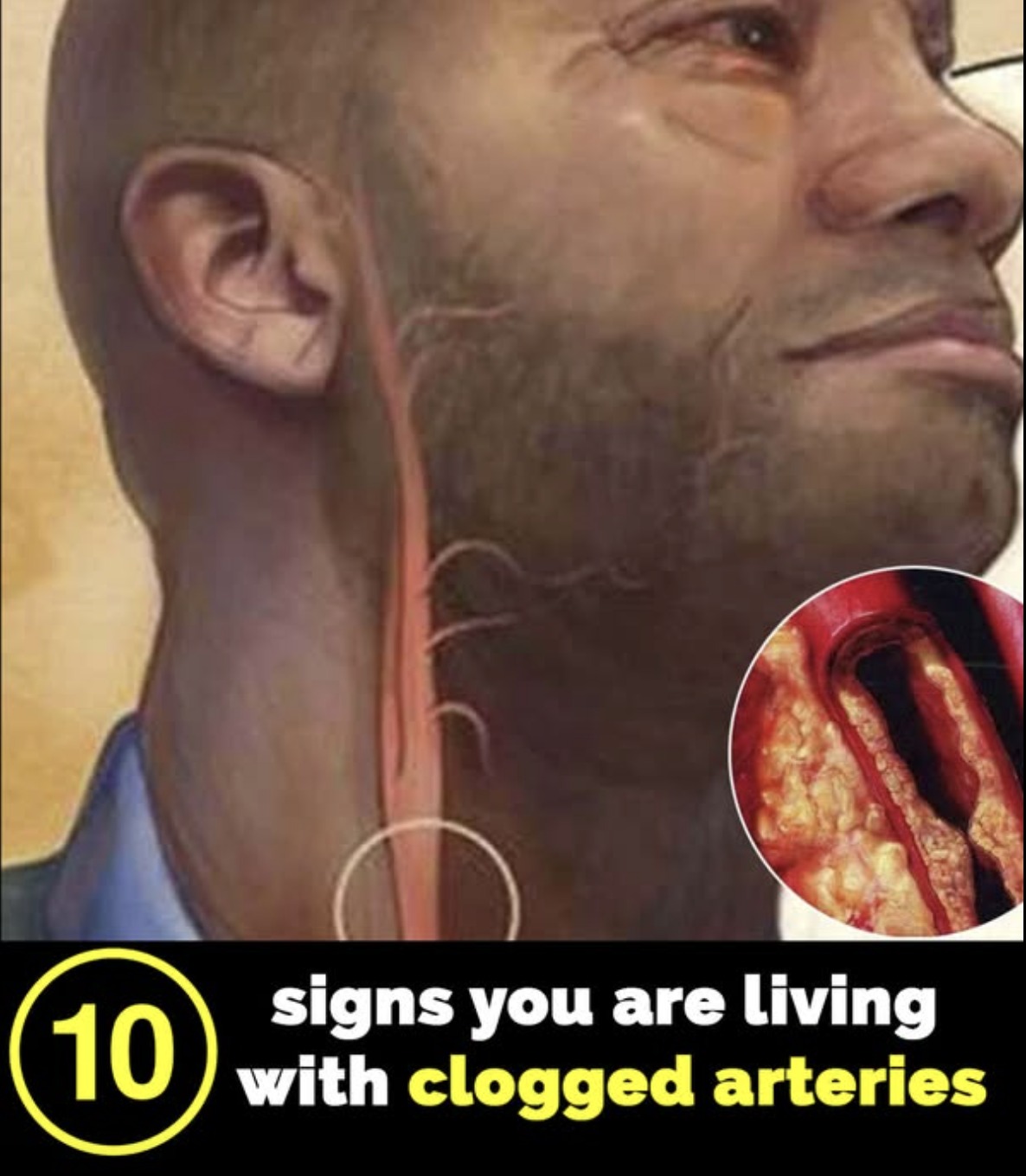 You are currently viewing Title: 10 Key Signs Your Arteries Might Be Clogged: Don’t Ignore These Health Warnings