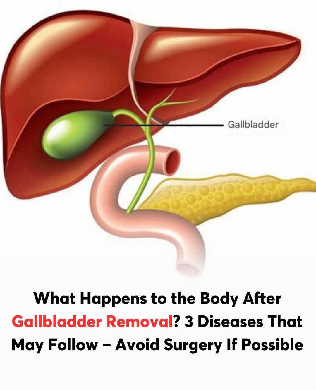 Read more about the article What to Expect After Gallbladder Removal: Side Effects and Dietary Tips