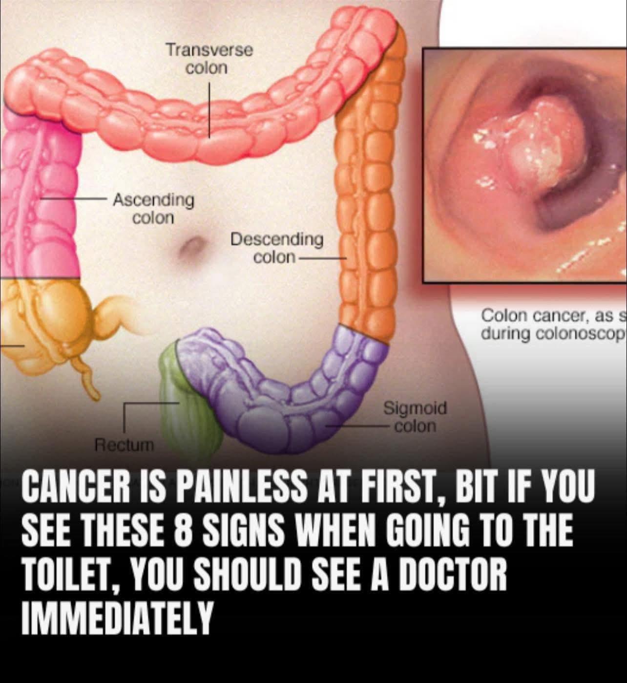 Read more about the article How Your Bowel Movements Reveal Clues About Colon Cancer