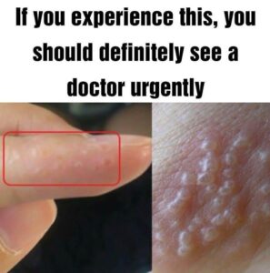 Read more about the article Dyshidrotic Eczema: Recognize the Signs of Painful Red Bumps on Your Skin