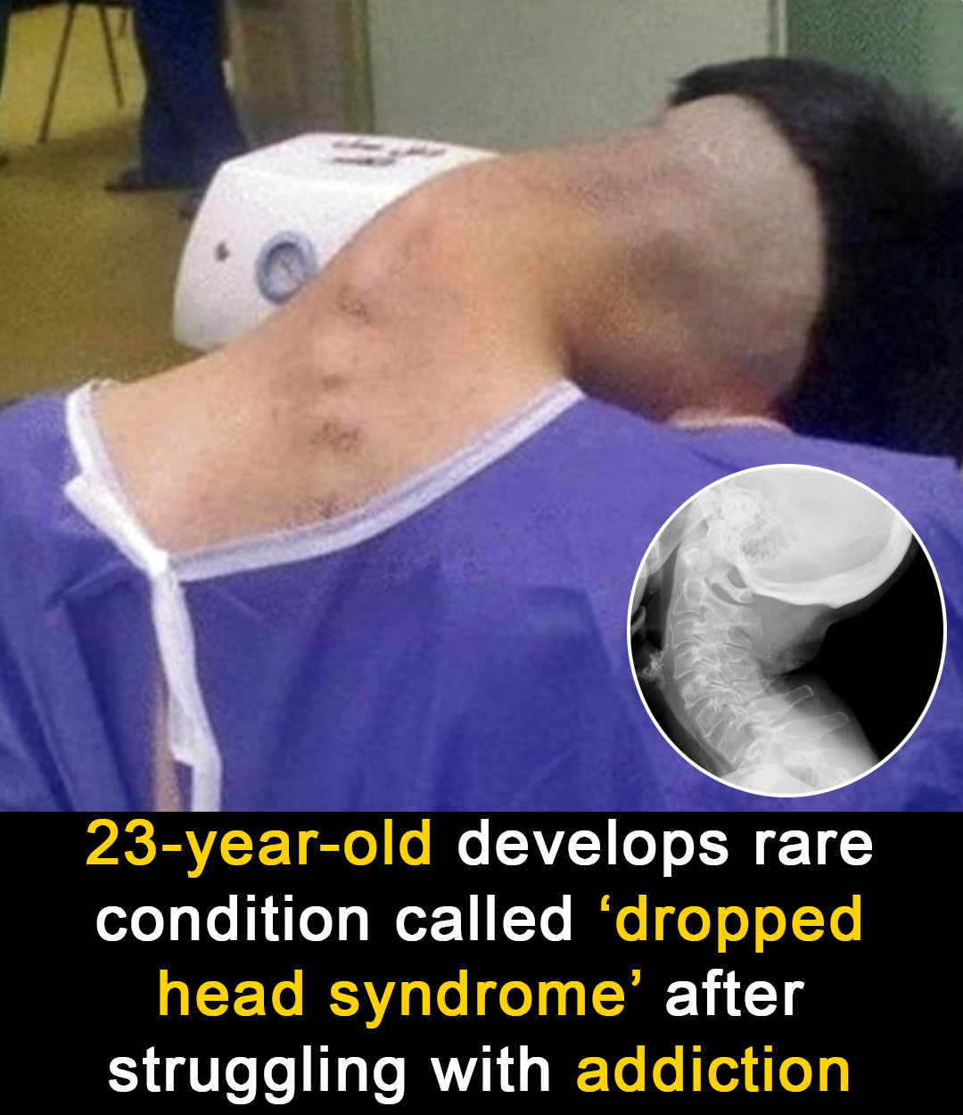 Read more about the article 23-Year-Old Develops Rare ‘Dropped Head Syndrome’ After Drug Abuse: Doctors Warn of Silent Spine Damage