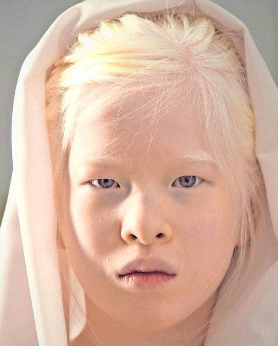 Read more about the article From Abandoned to Vogue: The Inspirational Story of a Girl With Albinism Who’s Changing the World