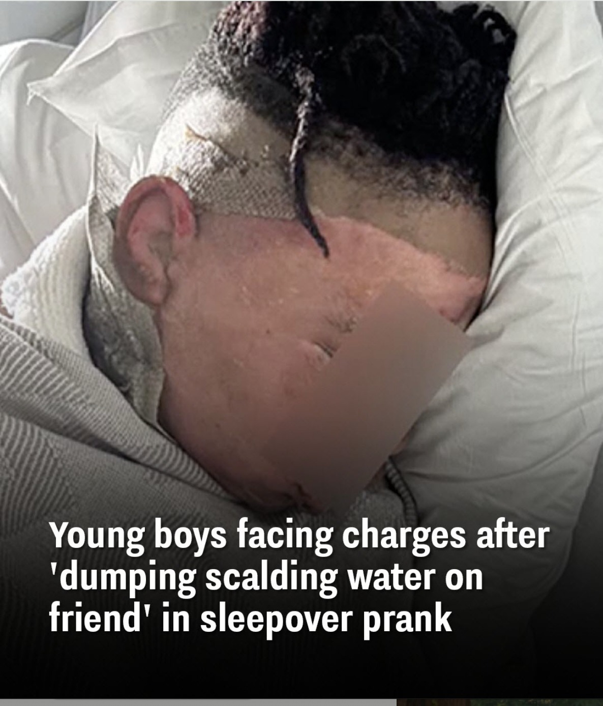 You are currently viewing Georgia Boy Suffers Severe Burns in Sleepover Prank Gone Horribly Wrong — Now His Recovery Is Inspiring Thousands