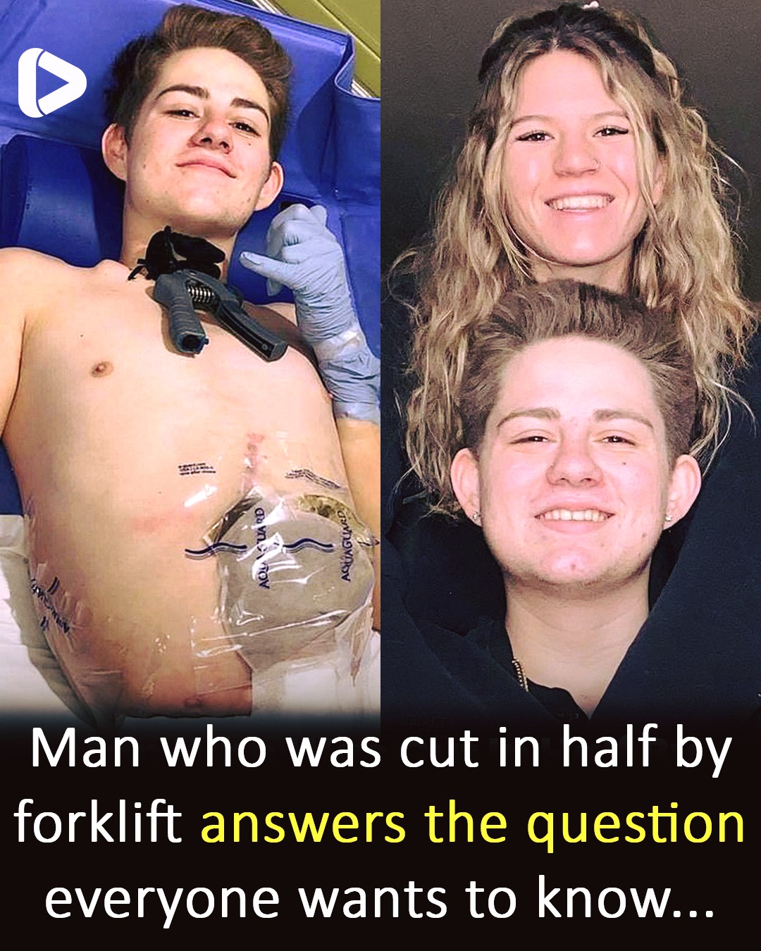 Read more about the article Crushed by a Forklift at 19, This Man Chose to Amputate Half His Body to Survive—Now He’s Inspiring Millions