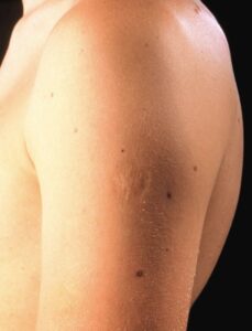 Read more about the article Smallpox Vaccine Scars: What They Look Like and Why They Formed