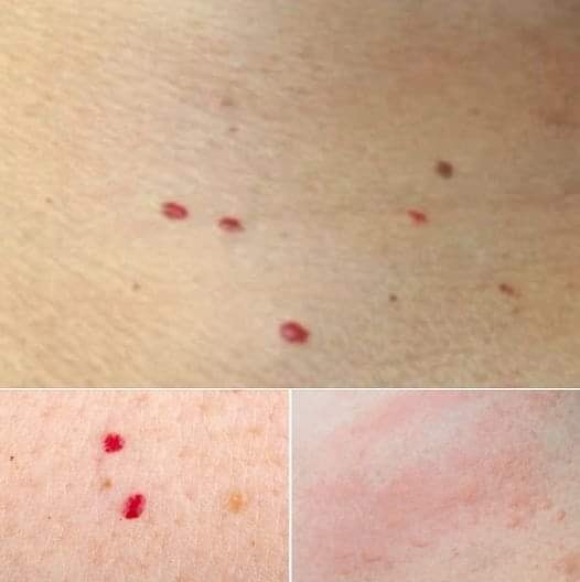 You are currently viewing Red Dots on Your Skin? Here’s What They Might Mean – And When to Seek Help