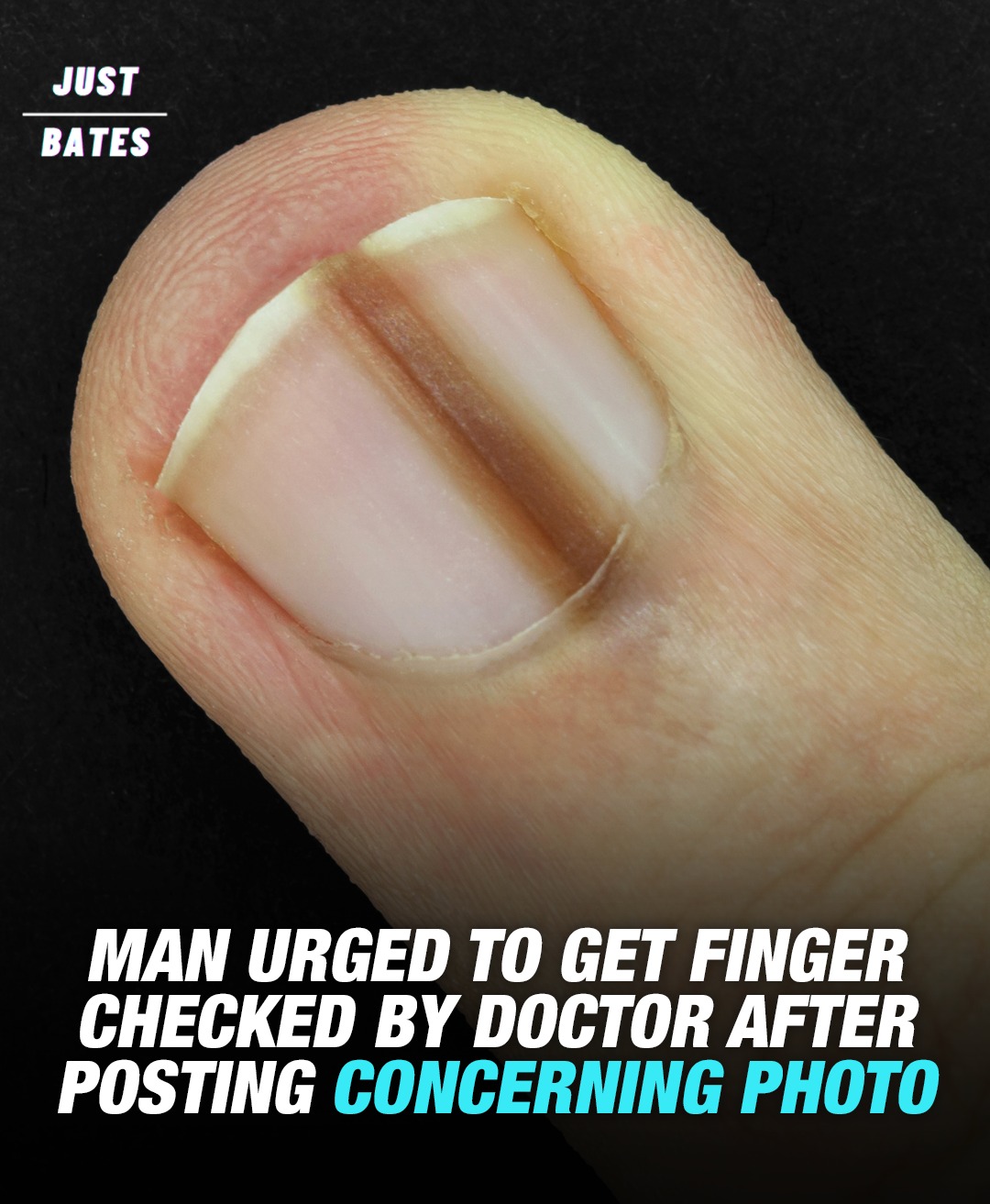 You are currently viewing Man Urged to Get Finger Checked by Doctor After Posting Concerning Photo of Fingernail