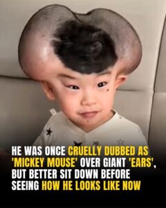 Read more about the article Boy Once Mocked as “Mickey Mouse” Transforms After Successful Surgery