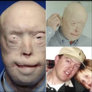 Read more about the article Firefighter Overcomes Devastating Injuries: The Story of Patrick Hardison’s Face Transplant