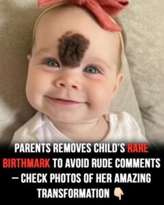 Read more about the article Parents’ Tough Decision to Remove Baby’s Rare Birthmark