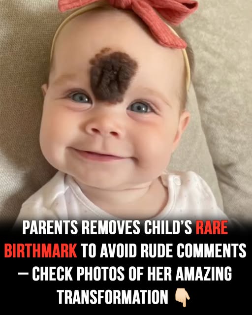 You are currently viewing Parents’ Tough Decision to Remove Baby’s Rare Birthmark