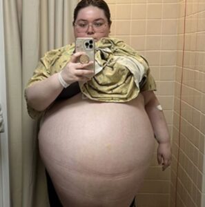 Read more about the article Woman’s Life Saved After Ovarian Cyst Grows to Over 100 Pounds – A Story of Courage and Health