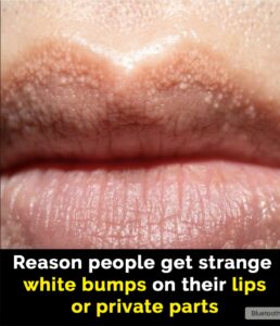 Read more about the article Reasons Behind ‘White Bumps’ on Lips and Other Areas: Understanding Fordyce Spots