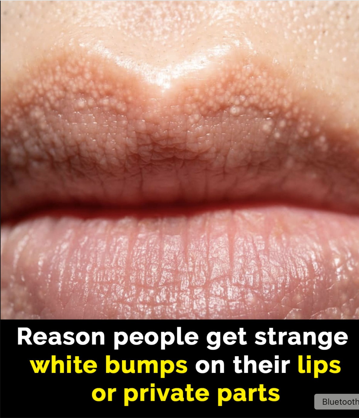You are currently viewing Reasons Behind ‘White Bumps’ on Lips and Other Areas: Understanding Fordyce Spots