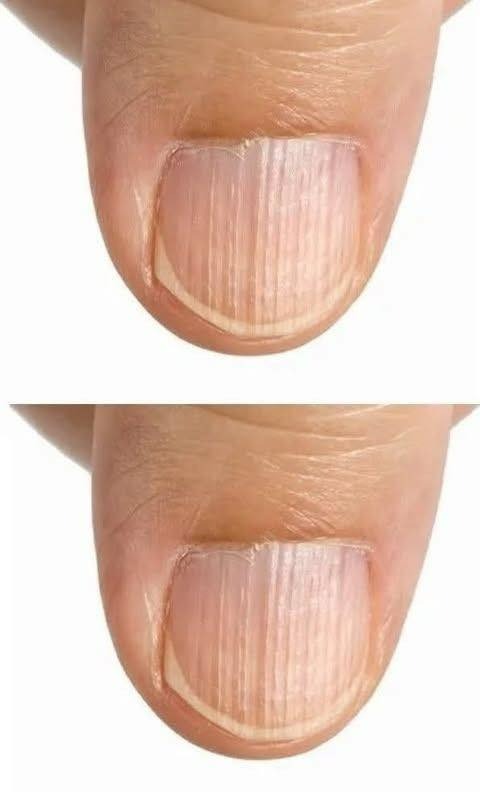 You are currently viewing Insurance and Your Health: What Ridges on Fingernails Really Mean