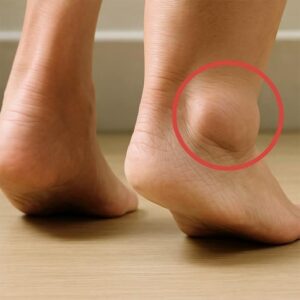 Read more about the article Swollen Legs and Feet: Causes, Symptoms & Natural Relief Methods