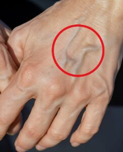 Read more about the article When to Worry About Veins That Appear Out of Nowhere