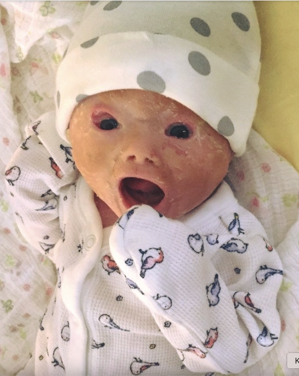 Read more about the article Dad Silenced as Baby Born with Harlequin Ichthyosis Shocks Doctors